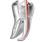 Endodonti (Kanal Tedavisi)