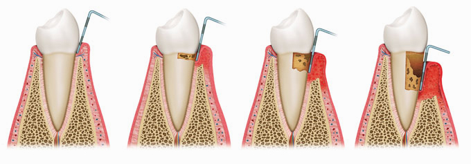 periodontoloji-2